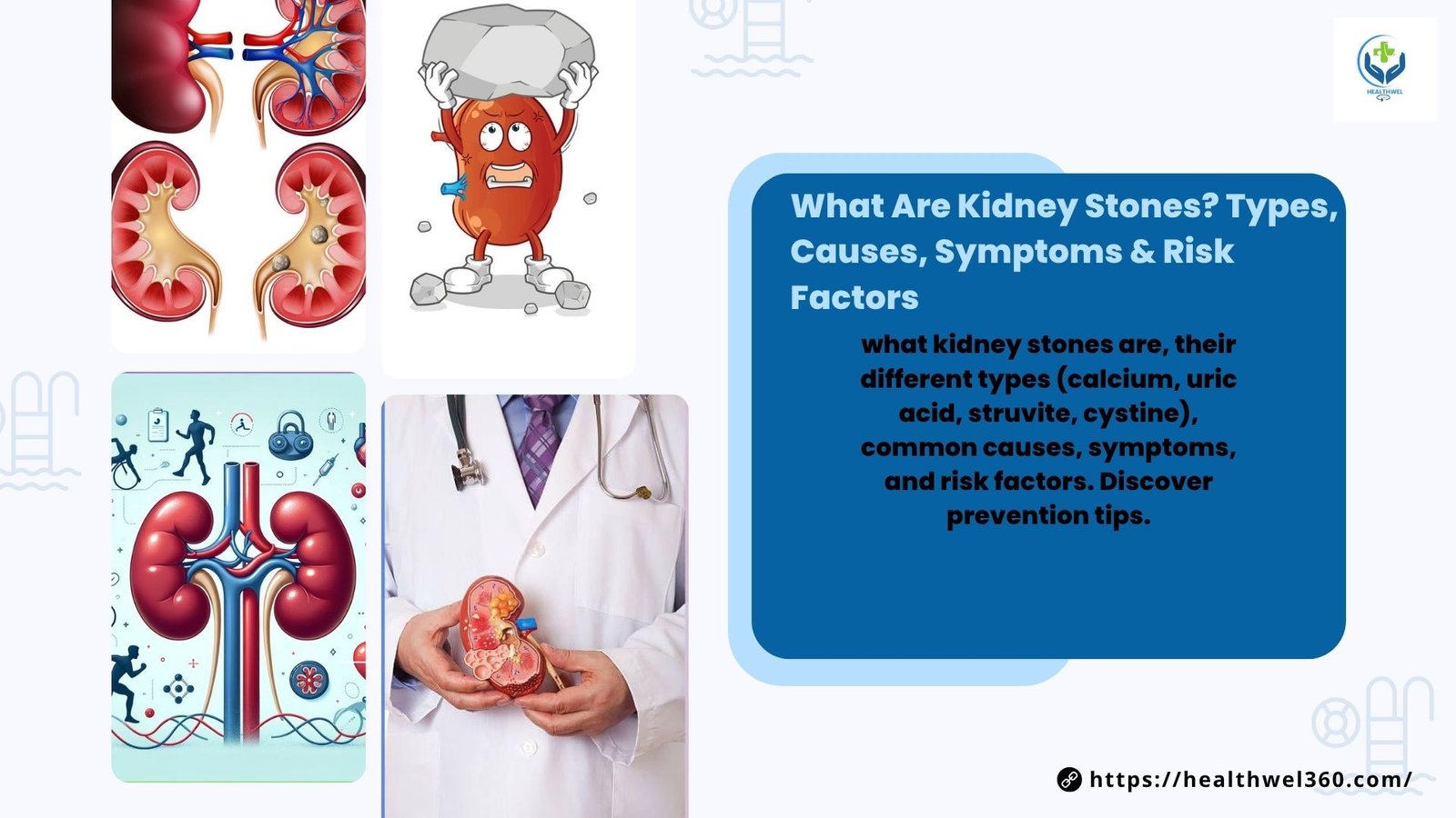 Kidney Stones